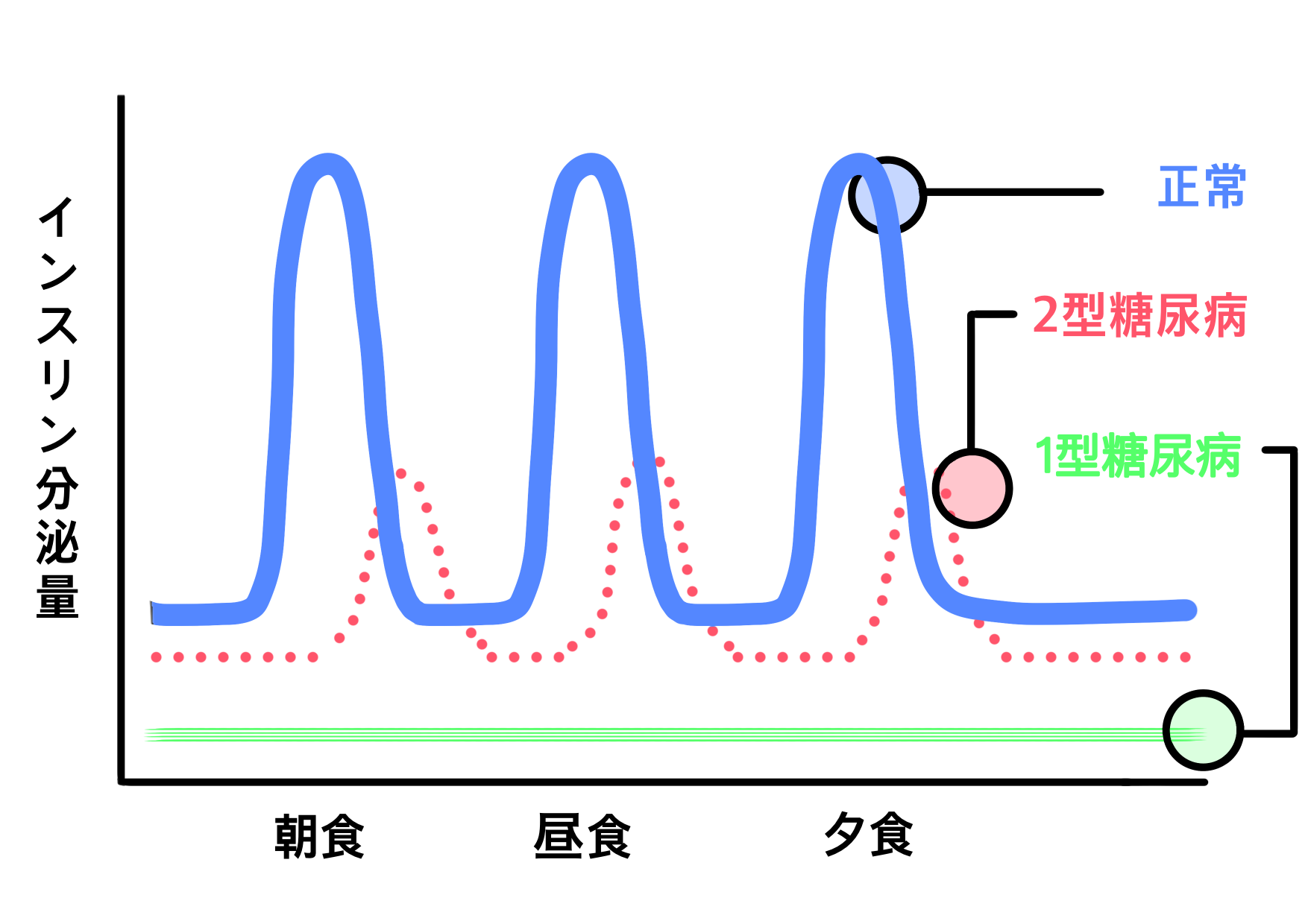 糖尿病　種類